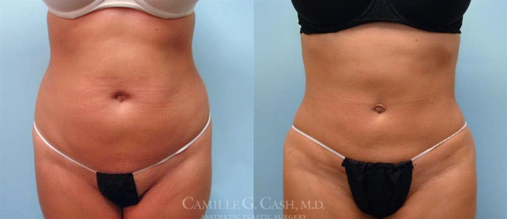 The Benefits of Arm Liposuction: A Comprehensive Guide