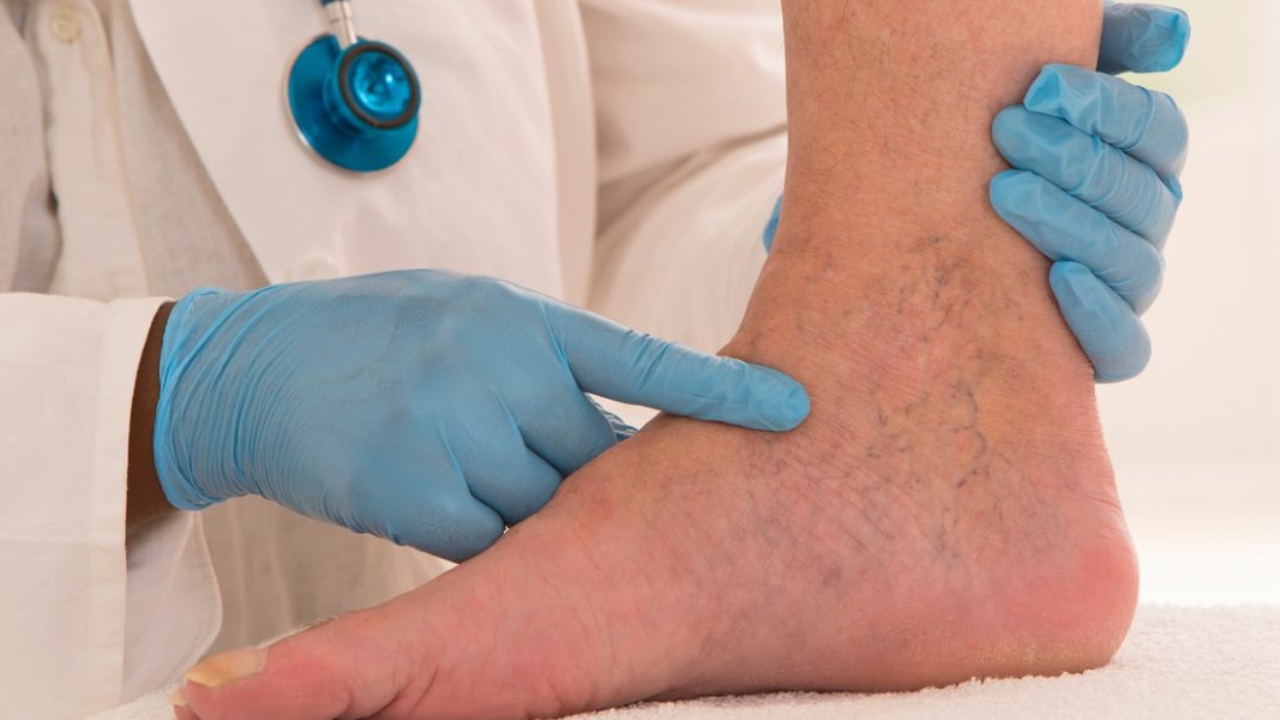 What Are the Benefits of Varicose Vein Treatments?