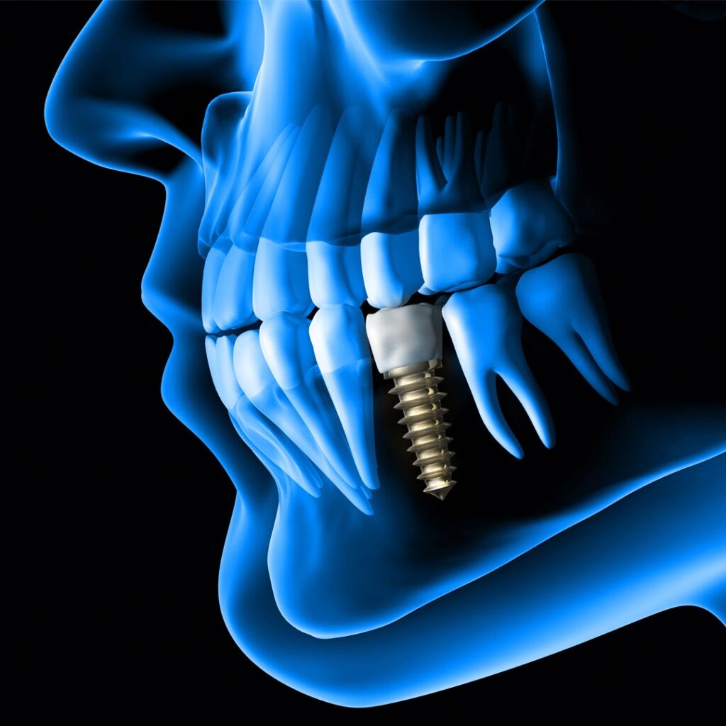 Same Day Dental Implants in Dubai