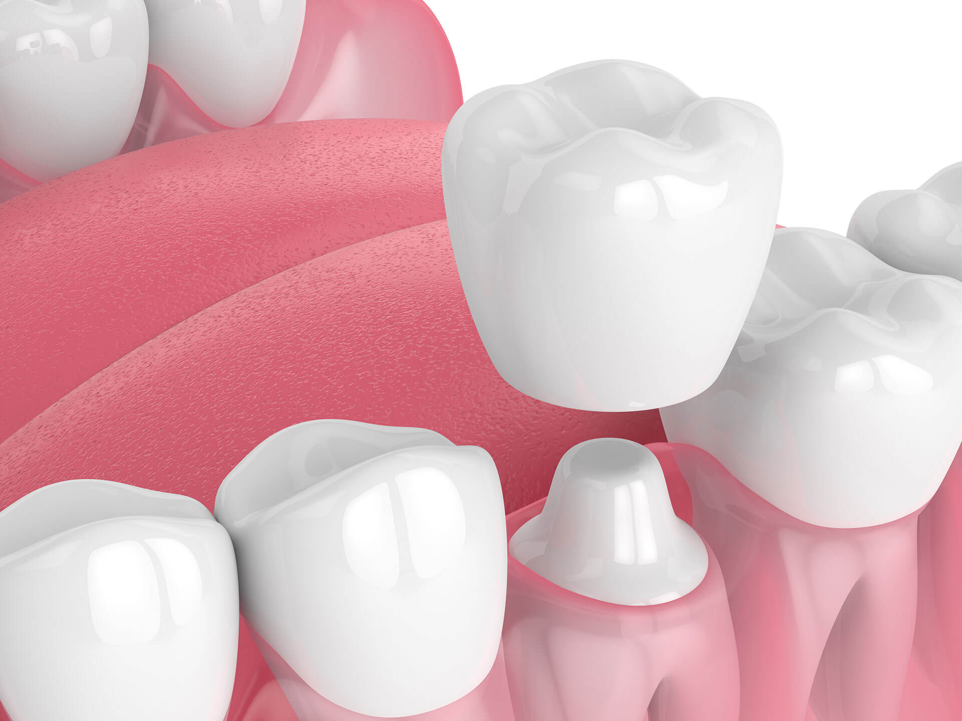 What Should You Do About A Temporary Dental Filling Emergency In Houston?