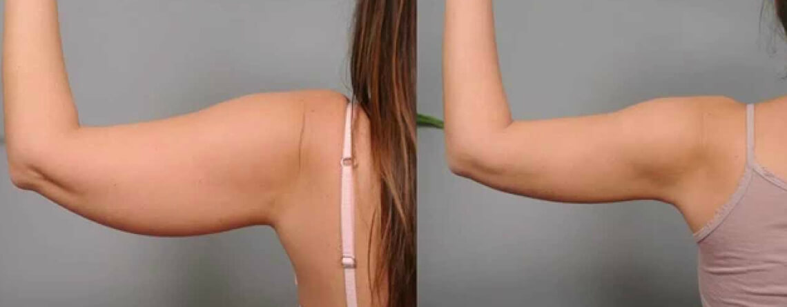 Bbl Scars: How Can Brazilian Butt Lift Surgery Minimize Them?