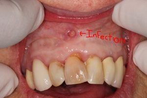 Where Can I Find The Best Dentist For Adults Near Me For Wisdom Teeth Extraction?